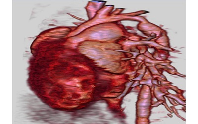 Multidetector Computer Tomography in Congenital Heart Disease