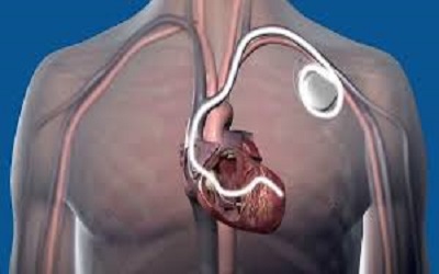 Propofol Administration by Electrophysiologist Versus an Anesthesiologist During Cardiac Resynchronization Therapy-Defibrillator(Crt-D) Implantation: Is an Anesthesiologist Necessary?