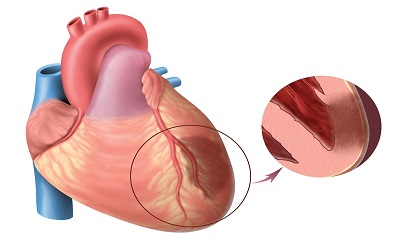 Plasminogen Activator Inhibitor-1 (PAI-1) 4G/5G Allele Polymorphisms and NIDDM(Non-Insulin Dependent Diabetes Mellitus) Risk Factor for Early Onset Myocardial Infarction