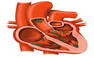 Infective Endocarditis in Chronic Hemodialysis: Involvement of the Left Heart or the Right Heart?