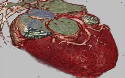 Echocardiography in Selecting Pediatric Patients and Congenital Heart Disease Patients for Resynchronization Therapy