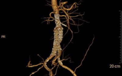 Use of Tube Stent-Grafts Combined with the Chimney Technique in Juxtarenal Saccular Aortic Aneurysms with Sufficient Distal Neck