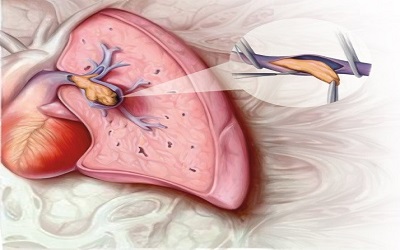 Chronic thromboembolic pulmonary hypertension in a case with multi-drug resistant pulmonary tuberculosis