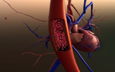 Platelet Dysfunction and Coronary Artery Disease
after Pediatric Kidney Transplantation