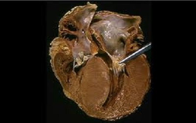 Complete Heart Block as a Presentation of Viral Myocarditis