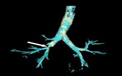 Endovascular Treatment of Iliac
Artery Stenosis in Patients with
Renal Transplant and Pelvic
Ectopic Kidney: Rare Two
Cases