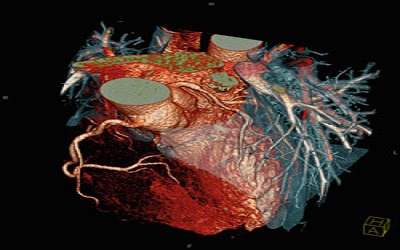 Excimer Laser Angioplasty in Calcified Coronary Lesions: Evidence of Calcium Ablation by Optical Coherence Tomography