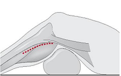 Anterior Tibial Artery
Entrapment Syndrome: An
Unusual Cause of Angiosomal
Ischaemia