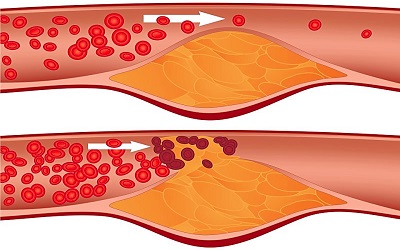 Statin Therapy is Associated with Reduction of Epicardial Adipose Tissues and Coronary Plaque Volumes with Vulnerable Composition, Measured by Computed Tomography Angiography