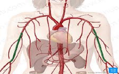 Revascularization of TASC
C/D Iliac Occlusion Extended
to Common/Superficial
Femoral Artery using a Mixed
Endoluminal and Subintimal
Technique through the RadioBrachial
Access