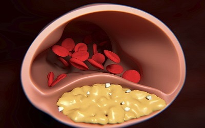 Clinical Profile, Angiographic Characteristics And Treatment Recommendations Of Coronary Artery Disease In Women