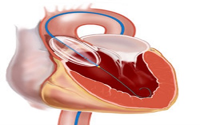 Aortic Ballon Valvuloplasty Is Still A Valuable Option For High Risk Patients With Severe Aortic Stenosis Before Surgery For Hip Fracture