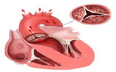 Successful Surgical Intervention in Symptomatic Severe Hypertrophic Subaortic Stenosis