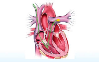 Pulmonary Venous Hypertension- An On Going
Quest for Treatment: Is PDE5 Inhibition the Right Solution?