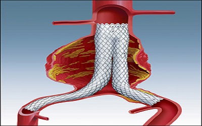 Modified Chimney Technique for the Emergent Treatment of Abdominal Aortic Graft
Rupture: A Cardiologist's Point of View