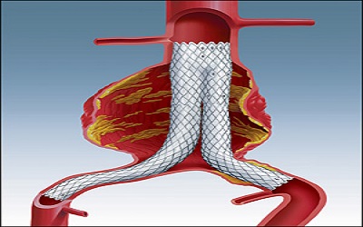 Modified Chimney Technique for the Emergent Treatment of Abdominal Aortic Graft
Rupture: A Cardiologist's Point of View