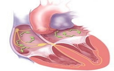 Extreme Coumadin Resistance in a patient with atrial fibrillation and End Stage Renal Disease