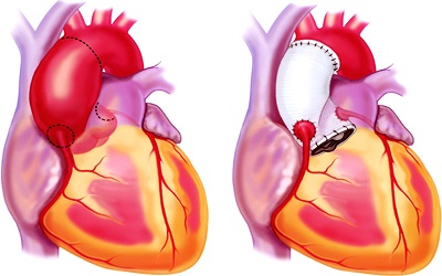 Extensive Retrograde Coronary Dissection into the Ascending Thoracic Aorta, Clinical Case Report