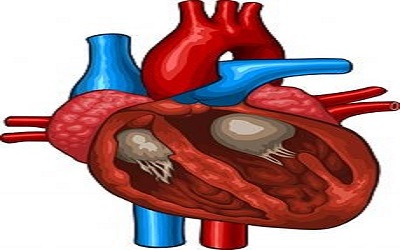 Arrhythmogenic Right Ventricular Cardiomyopathy: A Case Presentation with a Review