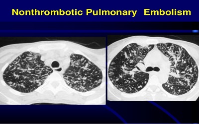 Pulmonary Tumor Macro Embolism Caused by Esophageal Squamous Cell Carcinoma: A Rare Case Report