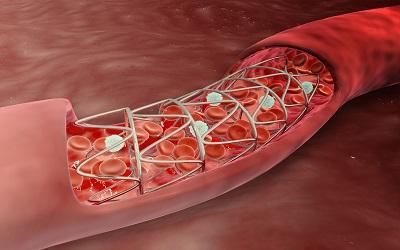 Differences in the Development of Restenosis Over Time for Various Drug-Eluting Stents