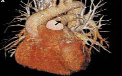 Cardiac MRI Volumetric Assessment by Short-Axis has Better Reproducibility
than the Axial Orientation in Functionally Single Right Ventricle Hearts Prior to
Bidirectional Cavopulmonary Anastomosis