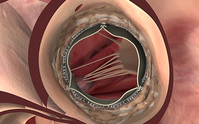 Using Na3PO4 to Enhance In vitro Animal Models of Aortic Valve Calcification