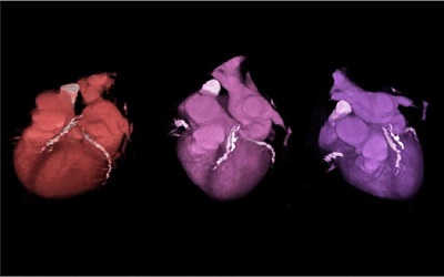 Noninvasive Coronary Artery Calcium Scoring: Do We Always Need Invasive Computed Tomographic Angiography for Diagnostic Purposes?