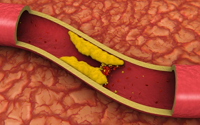 Effect of Phase 2 Cardiac Rehabilitation Program on High Sensitivity C-Reactive Protein Levels in Post-Percutaneous Coronary Intervention Patients