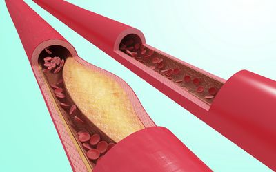 The Effect of Periodontal Therapy on Atherosclerosis in Cardiovascular Disease:
Clinical, Biochemical, Microbiological and Experimental Study