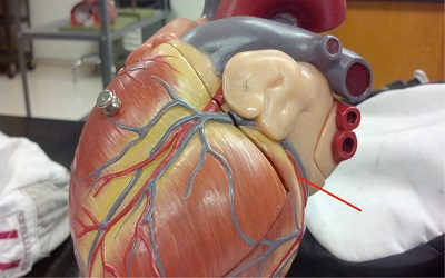 Anomalous Left Circumflex Artery Originating from Right Sinus of Valsalva: A Case Report