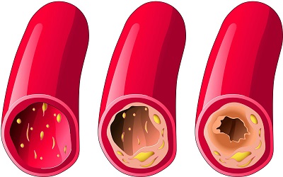 Association of Carotid Intima Media Thickness and Periscope Markers with Coronary Artery Disease, Risk factors and Biomarkers in Asian Indians