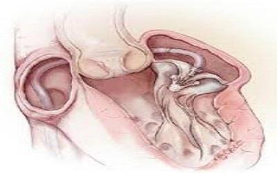 Early and Mid-Term Safety and Efficacy Outcomes After Mitra Clip Implantation in a Real- World Patient Cohort with High Surgical Risk â€“ Insights from the Dresdner Mitra Clip Registry