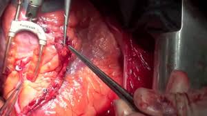 Implications of Hemodialysis in Patients Undergoing Coronary Artery Bypass Grafting