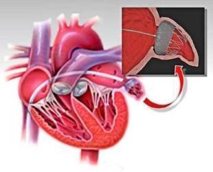 Safety of Percutaneous Left Atrial Appendage Occlusion in Patients with Atrial Fibrillation after Acute Coronary Syndrome: A Single Center Experience