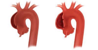 Higher Incidence of Acute Aortic Dissections in Winter Months- Results of the German Registry for Acute Aortic Dissection Type A