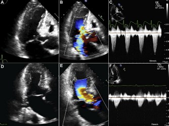 Takostubo Cardiomyopathy Induced by Dobutamine Infusion