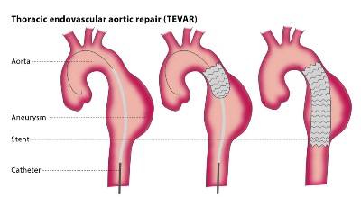 Effect of Lumbar Drainage on the Outcome of Thoracic Endovascular Aortic Repair (TEVAR): Contemporary Results