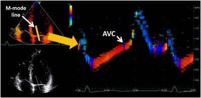 The Effect of Exercise on the Timing of Aortic Valve Closure with Respect to the ECG Tracing