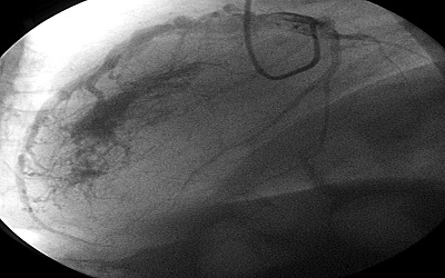 Observation of Left Ventriculography with a Single Left Coronary Injection via Unique Coronary-Cameral Fistulas