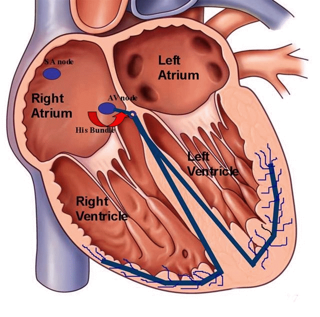 Ablation of Atrioventricular Nodal Reciprocating Tachycardia in Pregnancy with an Irrigated Catheter and Non-fluoroscopic Mapping System