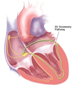 Ablation of Atrioventricular Nodal Reciprocating Tachycardia in Pregnancy with an Irrigated Catheter and Non-fluoroscopic Mapping System