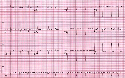 Self-Treatment Techniques in Patients with Paroxysmal Atrial Fibrillation and the Probable Influence of the Autonomic Nervous System