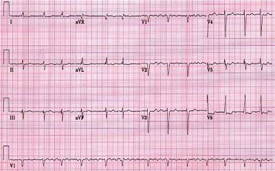 Self-Treatment Techniques in Patients with Paroxysmal Atrial Fibrillation and the Probable Influence of the Autonomic Nervous System