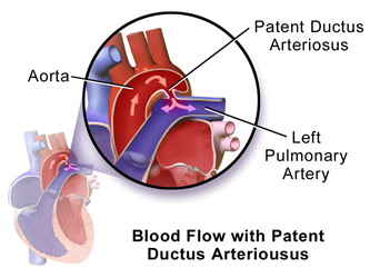 Could the Size of Ductus Arteriosus be an Independent Predictor for the changes in Left Ventricular Function Post Percutaneous closure! Evaluation by Tissue Doppler and Speckle-derived Strain Rate Echocardiography