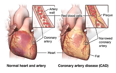 Association between Albuminuria and Severity of Coronary Artery Disease detected by Angiography in Patients with Type 2 Diabetes Mellitus