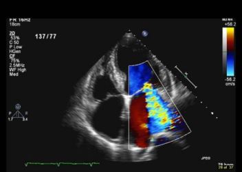 Impact of Balloon Mitral Valvuloplasty on Net Atrioventricular Compliance and Echocardiographic Assessment of Mitral Valve Area by Pressure Half Time versus Proximal Isovelocity Surface Area