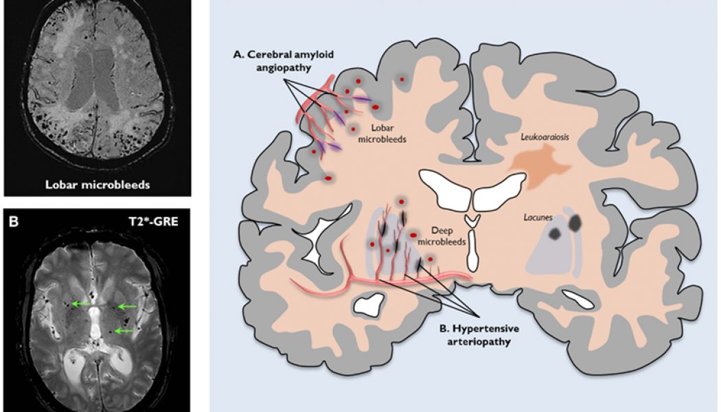 Cerebral Micro bleeds in Coronary Artery Disease Patients during Antiplatelet Therapy