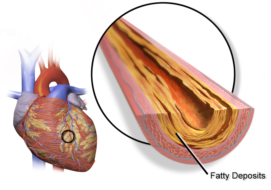 Differential Analysis of Nitroglycerin Influence on Myocardium in Coronary Artery Disease Patients