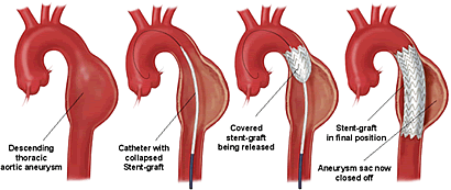 Significant Iatrogenic High Flow AV-Communication after MitraClip Treated with Endovascular Covered Stent